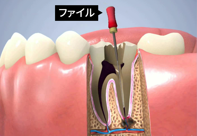 根管治療